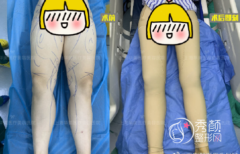 上海华美何斌吸脂怎么样,多少钱?附大腿吸脂案例分享