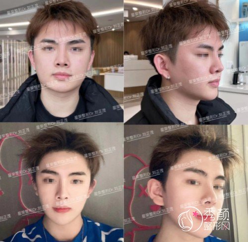 重庆星荣整形外科医院刘正茂院长磨骨怎么样,有没有失败案例?