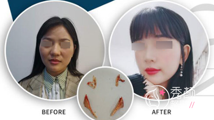 刘先超磨骨技术怎么样？来看看刘先超几个磨骨真实案例效果！