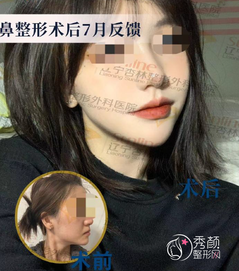 沈阳杏林朱石江隆鼻怎么样，有没有失败案例？附隆鼻真实案例分享