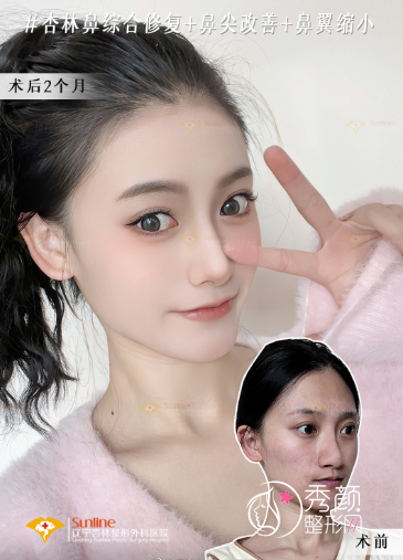 沈阳杏林朱石江隆鼻怎么样，有没有失败案例？附隆鼻真实案例分享