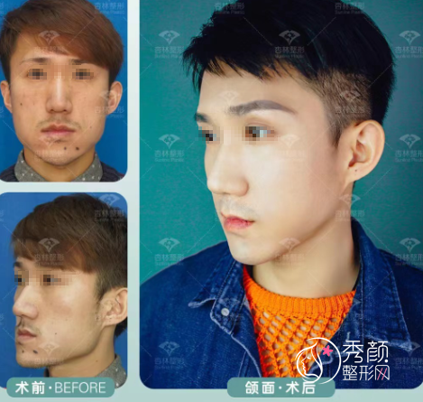 沈阳杏林朱石江医生正颌手术怎么样？附正颌手术案例