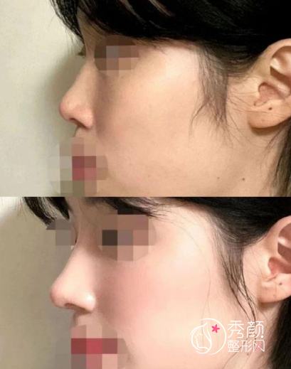 北京丽合医疗美容医院薛轶群隆鼻怎么样，多少钱？附真实隆鼻案例