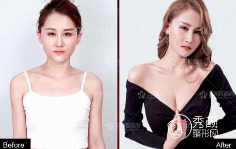 沈阳百嘉丽李衍江隆胸怎么样，有没有失败案例？附隆胸案例
