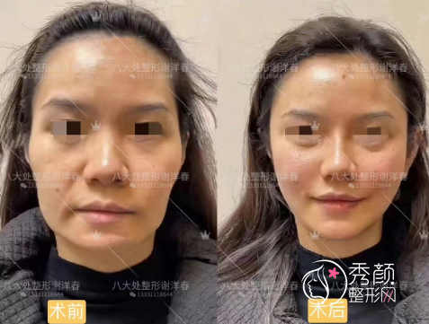 北京八大处谢洋春拉皮手术怎么样，多少钱？附拉皮手术案例