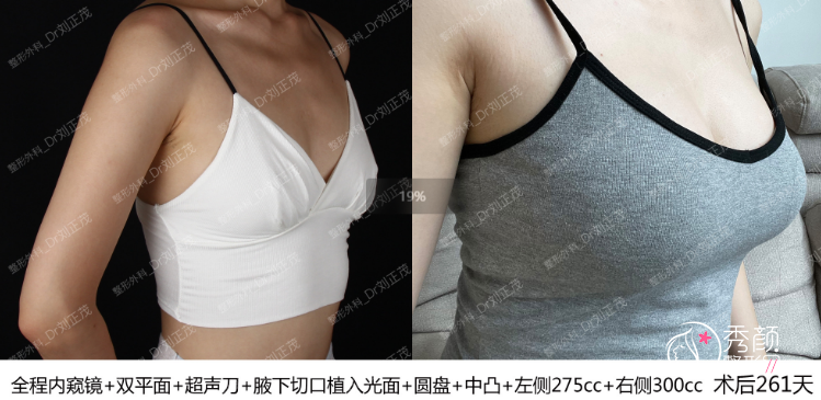 重庆星荣整形外科医院刘正茂隆胸怎么样，有没有失败案例？
