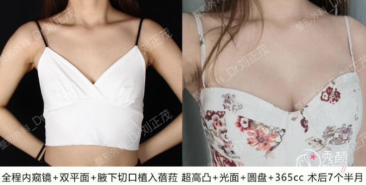 重庆星荣整形外科医院刘正茂隆胸怎么样，有没有失败案例？