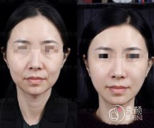 广州陈兵拉皮手术效果如何？从陈兵教授拉皮案例来看技术真的靠谱！