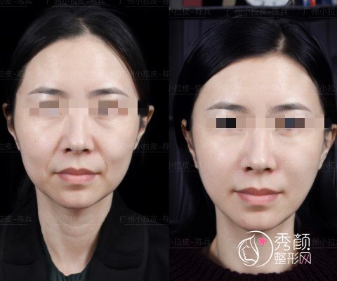 广州陈兵拉皮手术效果如何？从陈兵教授拉皮案例来看技术真的靠谱！