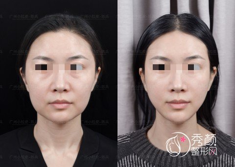 广州陈兵拉皮手术效果如何？从陈兵教授拉皮案例来看技术真的靠谱！