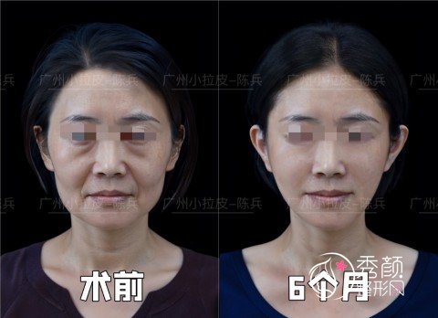 广州陈兵拉皮手术效果如何？从陈兵教授拉皮案例来看技术真的靠谱！