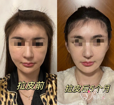 北京刘文阁拉皮手术做得怎么样，有没有失败案例？附真实拉皮案例