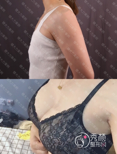 北京八大处穆大力隆胸技术怎么样？附穆大力隆胸收费标准