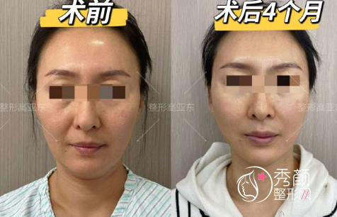 北京华韩高亚东拉皮技术怎么样，效果好吗？附高亚东拉皮手术案例