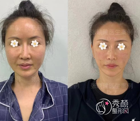 上海张晓建院长拉皮手术做得怎么样，有没有失败案例？