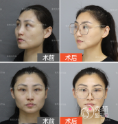 <b>北京磨骨张笑天和邱立东哪个做的好？案例技术审美口碑分析</b>