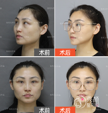北京磨骨张笑天和邱立东哪个做的好?案例技术审美口碑分析