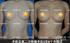 北京八大处自体脂肪隆胸多少钱？附医生介绍及案例分享