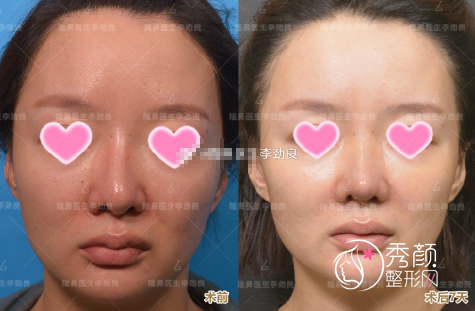 北京李劲良鼻修复怎么样？从鼻修复案例来看李劲良技术很靠谱！