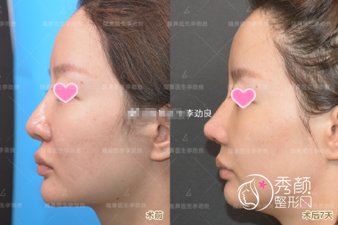 北京李劲良鼻修复怎么样？从鼻修复案例来看李劲良技术很靠谱！
