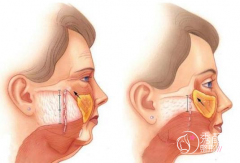 北京小拉皮手术哪个医生做得好？柳民熙、杜太超、黄寅守等医生技术不错！
