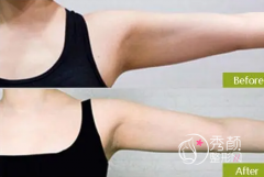 哈尔滨吸脂哪个医生好？