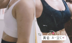 成都做假体隆胸哪个医生