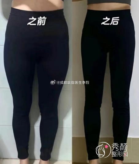 成都李烈吸脂怎么样，有没有失败案例？附大腿吸脂案例