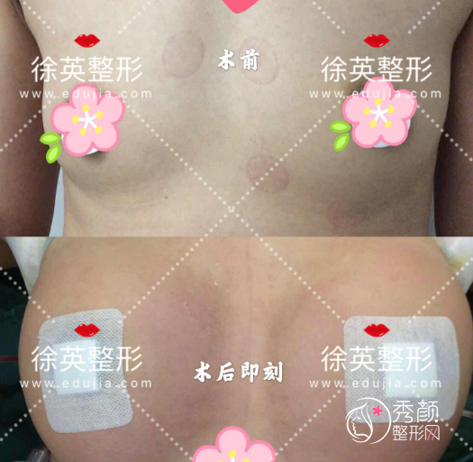 深圳艺星徐英医生隆胸怎么样，有没有失败案例？