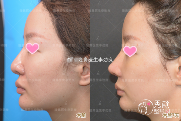 北京李劲良做鼻子怎么样，有没有隆鼻失败案例？附歪鼻修复案例