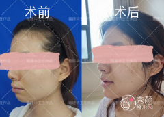 西安磨骨医生籍建华和李