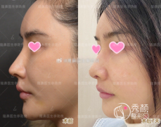 刘彦军和李劲良医生鼻修