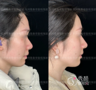 杭州隆鼻杨海波和徐利刚哪个医生更好？技术审美案例对比