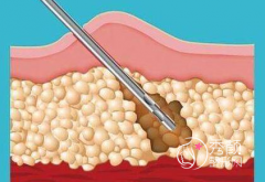 哈尔滨吸脂手术哪做的好？哈尔滨抽脂价格一览表