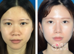 青岛隆鼻哪个医生好？徐立志、曹继武、黄旭培、车柄勋、赵煜楠等医生