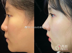 青岛伊美尔国宾杨国文和青岛诺美德姜留刚哪个隆鼻好？