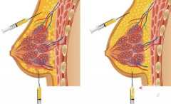 北京自体脂肪隆胸哪个医生好？李发成、王志坚、任学会等医生