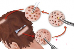 北京植发哪个医生好？八大处蒋文杰、北医三院谢祥、中山医院乔先民等医生