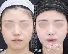 北京吸脂哪个医生好？顾
