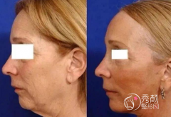 2024北京做大拉皮好的医生