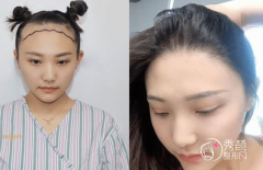 北京植发正规医院排名榜：北京画美、丽都、首瑞植发、艺星等医院上榜