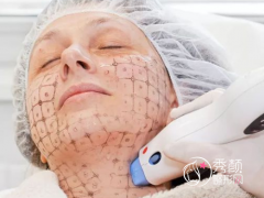 上海热玛吉哪家医院做的好？华美、时光、薇琳、首尔丽格等医院不错