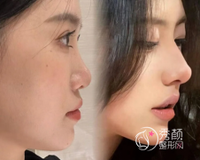 深圳隆鼻哪个医生比较好？陈桂飞、李信锋、朱灿、向宏伟、梁志为等