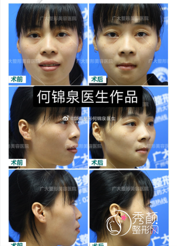 何锦泉正颌手术失败过吗？附何锦泉正颌手术案例