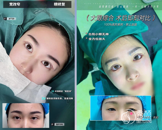 哈尔滨臻美王丹丹修复双眼皮好吗，有没有失败案例？