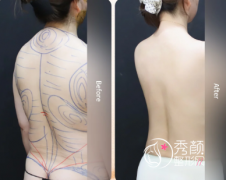 北京吸脂手术三甲医院排