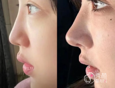 重庆爱贝芙注射哪个医生好？潘宝华、李富强、田鹏飞等医生技术不错！