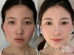 成都玻尿酸注射医生哪个好？张作香、谢雯、曹萍萍、金可等