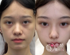 重庆玻尿酸注射填充哪个医院好？华美|艺星|星荣|美莱|当代各有优势