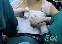 成都假体隆胸哪些医院比